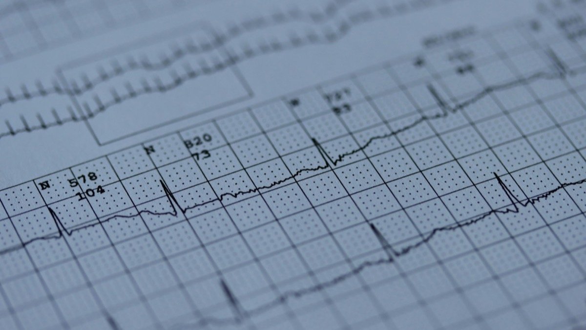 Electrocardiogram tracing on graph paper